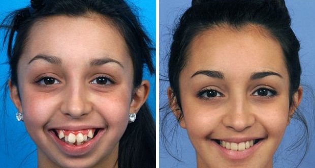 FOTO & VIDEO/ Ja si e ka shndërruar nofullën kjo 20–vjeçare