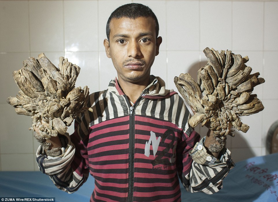 E RALLE/ Sëmundja po e kthen këtë njeri në pemë