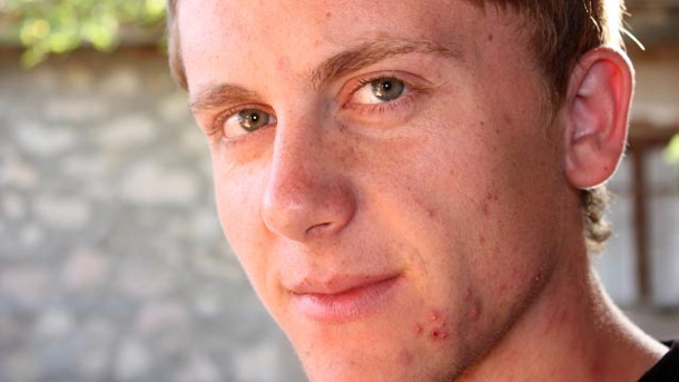 Ka një pija alkoolike që kuron aknet