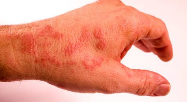 Përfundon në Polici mjeku që denoncoi në FB simptomat e pacientëve që punojnë me kanabisin në Tiranë