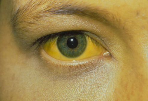 OBSH-ja sëmundja e rrezikshme që po merr pafund jetë njerëzish