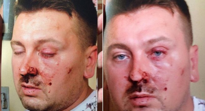 “Thurrje” denoncon: Policia në Korçë ushtron dhunë barbarisht ndaj një 31vjeçari