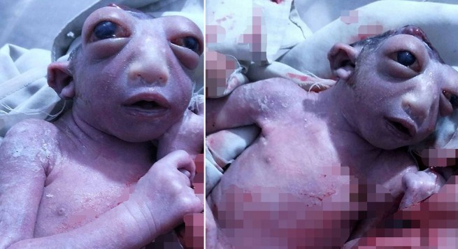 Lind fëmija me gjysmë kokë, shokohen doktorët