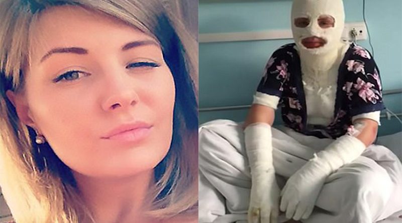 FOTO LAJM/ Pasojat e xhelozisë së sëmurë, i dashuri djeg të dashurën me acid e zjarr