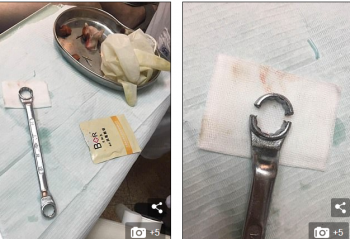 17 ORË TMERR/ Burrit i ngec penisi në një vegël pune, në “operacion shpëtimin” edhe zjarrfikësit