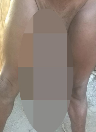 FOTO/ I riu që nuk bën dot seks, madhësia e penisit të tij do t’ju shokojë