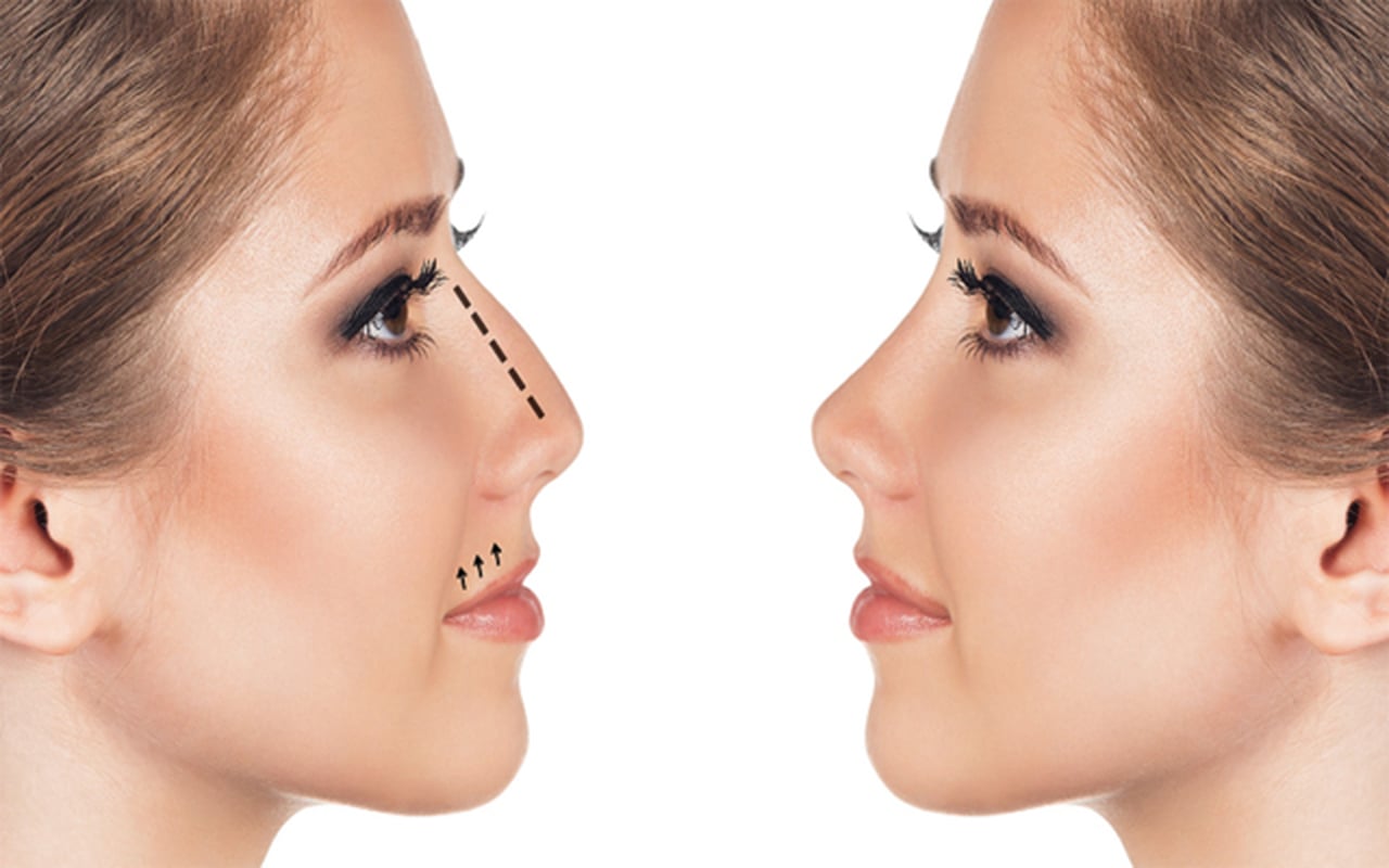 INTERVISTA/ Kompleksi i shqiptarëve: Forma e hundës, kredi për të kryer ndërhyrjen