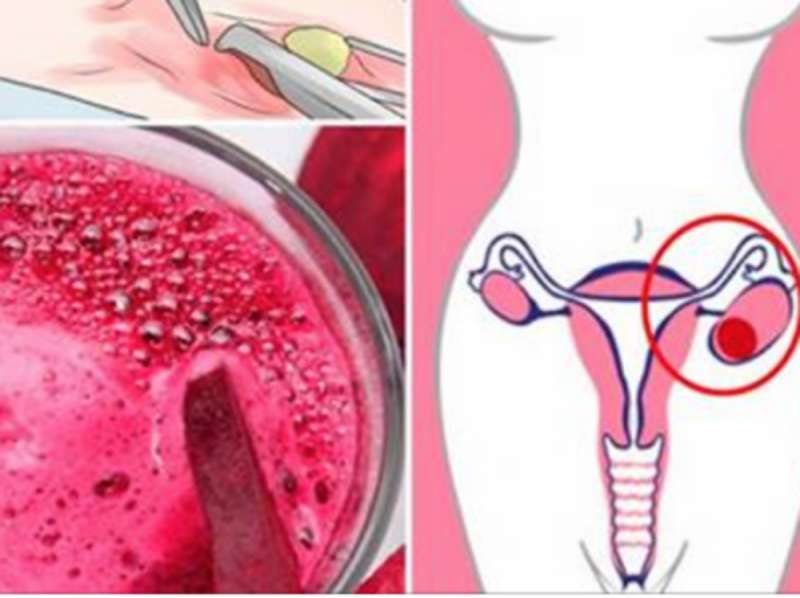 Si të zhdukni miomat dhe kistet e vezoreve me këtë pije të përgatitur në shtëpi