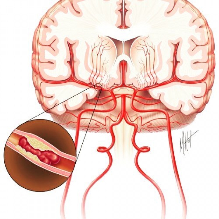Paraliza cerebrale, studiuesit hedhin hapat e parë për kurimin e saj