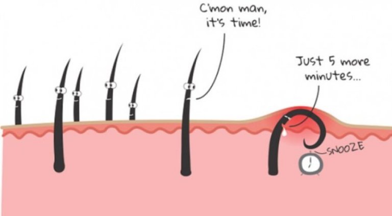 Si të stimuloni daljen e qimeve që rriten nën lëkurë