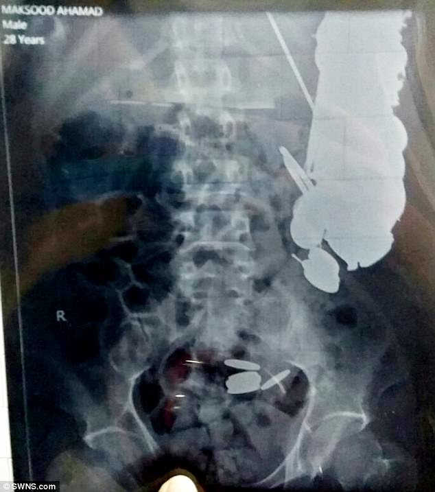 FOTO GALERI/ E rrallë, kirurgët i gjejnë pacientit monedha dhe gozhda “të fshehura” në stomak