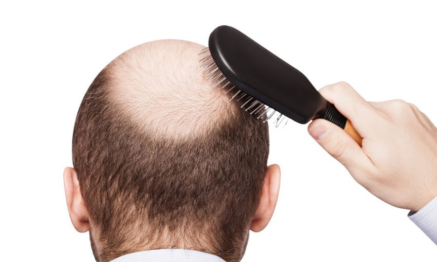 Zbulohet aksidentalisht kura kundër “tullacllëkut”