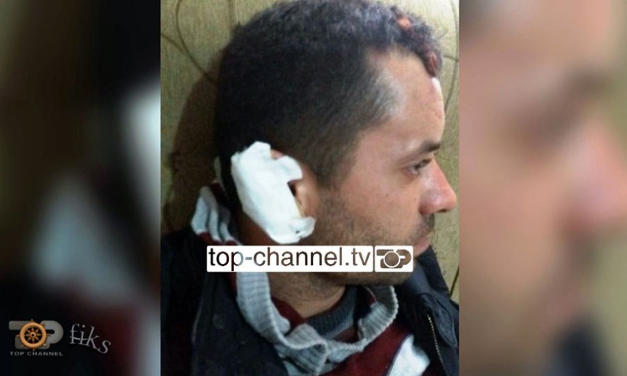 I presin veshin, prokuroria e quan plagosje të lehtë. Mjeku ligjor: Bëj operacion plastik!