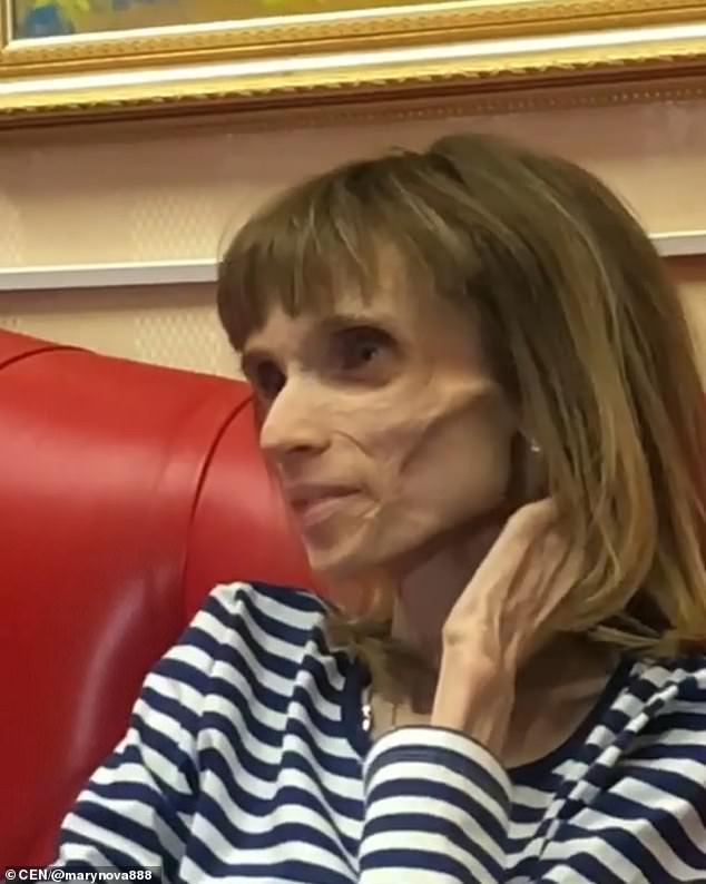 VIDEO/E ftojnë të luajë në film horror, gruaja rrezikon të vdesë nga anoreksia