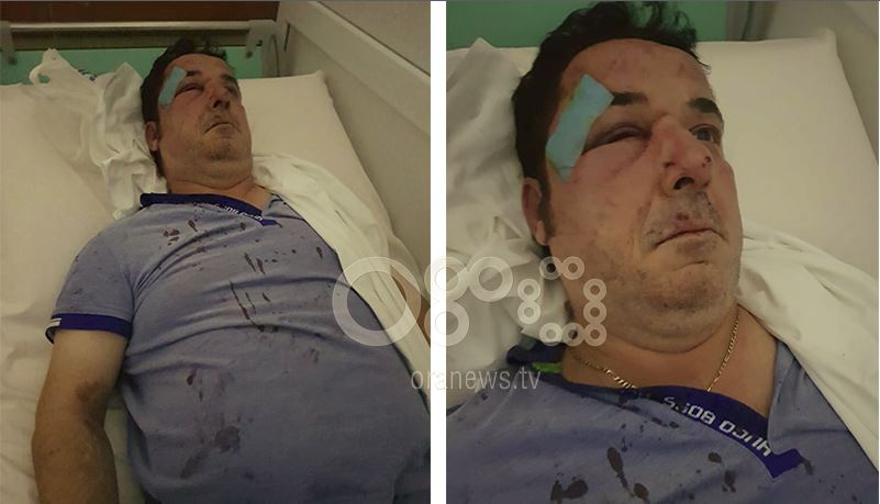 Dhunohet biznesmeni në Tiranë, çështja pushohet në prokurori