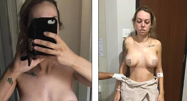 FOTO/Pas operacionit të gjoksit, infermierja publikon fotot me rezultatin e tmerrshëm