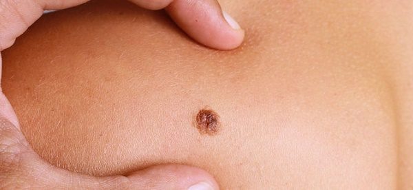 Apeli i mjekëve, kontrolloni nishanet dhe kujdes nga rrezet e diellit