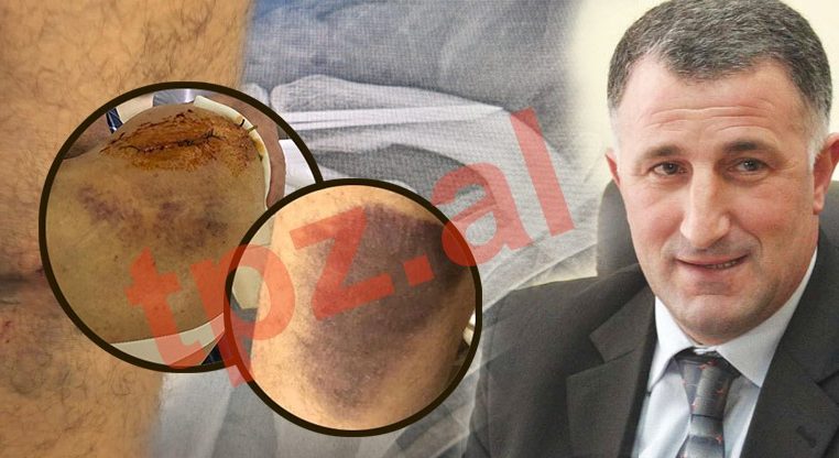 FOTO/ Flet Sait Dollapi: U dhunova në mënyrë të pamëshirshme, isha në detyrën time