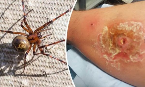 Njerëz të pickuar nga merimanga e zezë dhe gjarpri, shtohen rastet në spitalin e Fierit