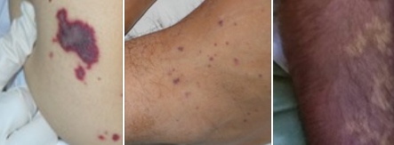 FOTO/Virusi i rrallë në Shqipëri, mjeku thirrje: Si trajtohet PF dhe si të mbroheni në rast kontakti